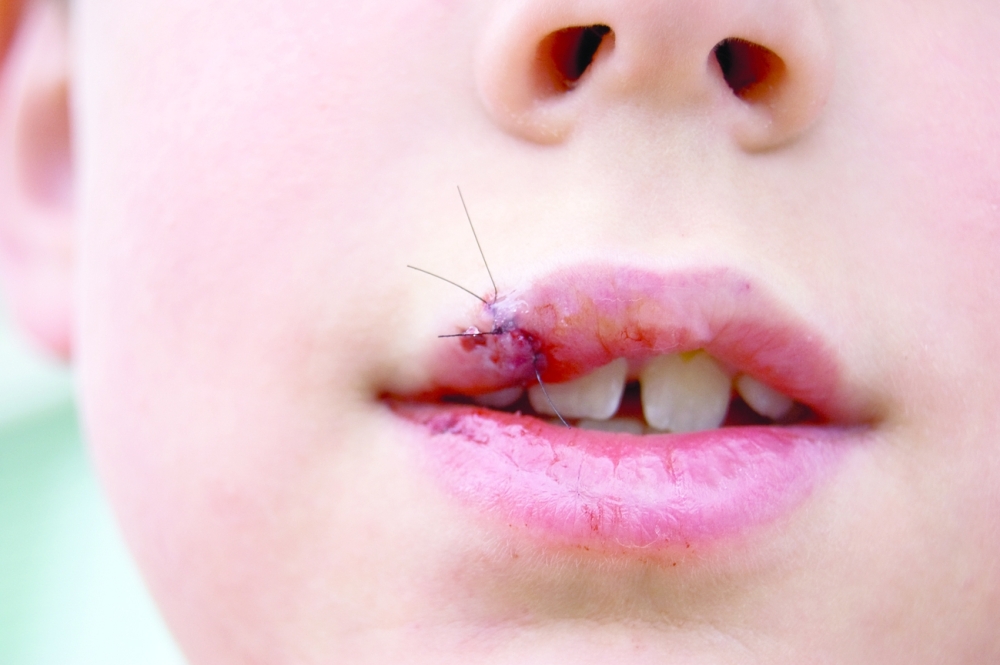 Stitches,In,Fat,Lip