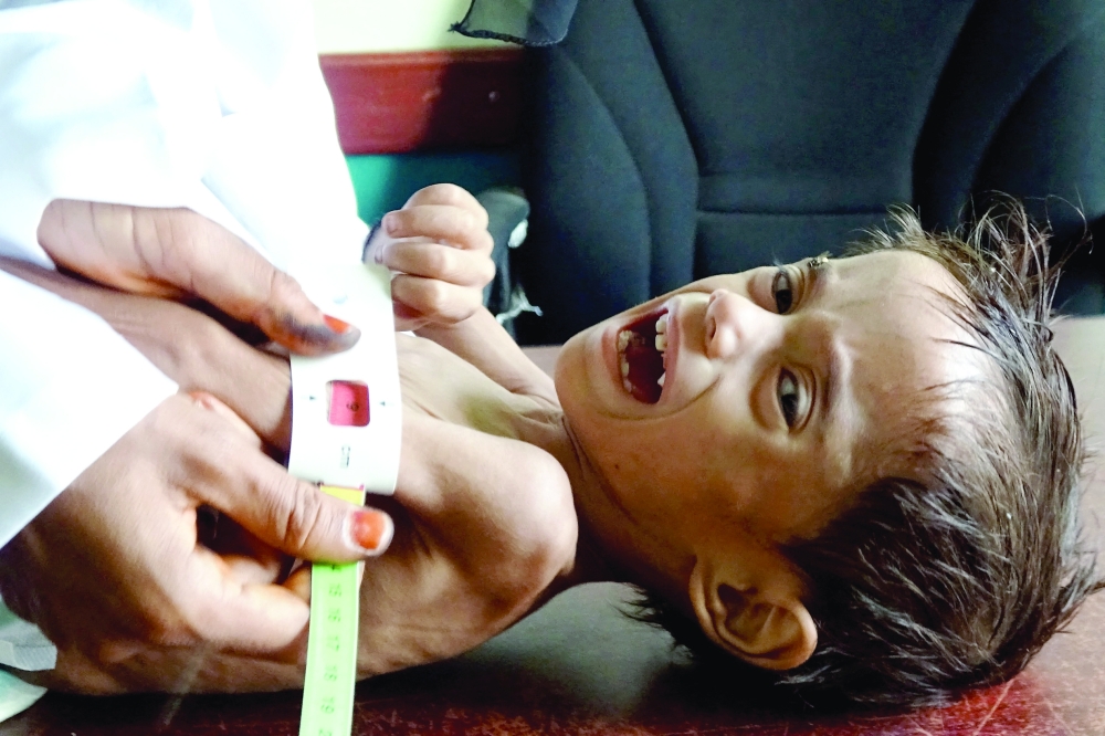 Ahmed Abdo Salem, a two-year-old Yemeni child displaced by conflict suffering from malnutrition (weighing only five kilograms) is measured at a health clinic in the war-ravaged western Hodeida province. AFP file photo