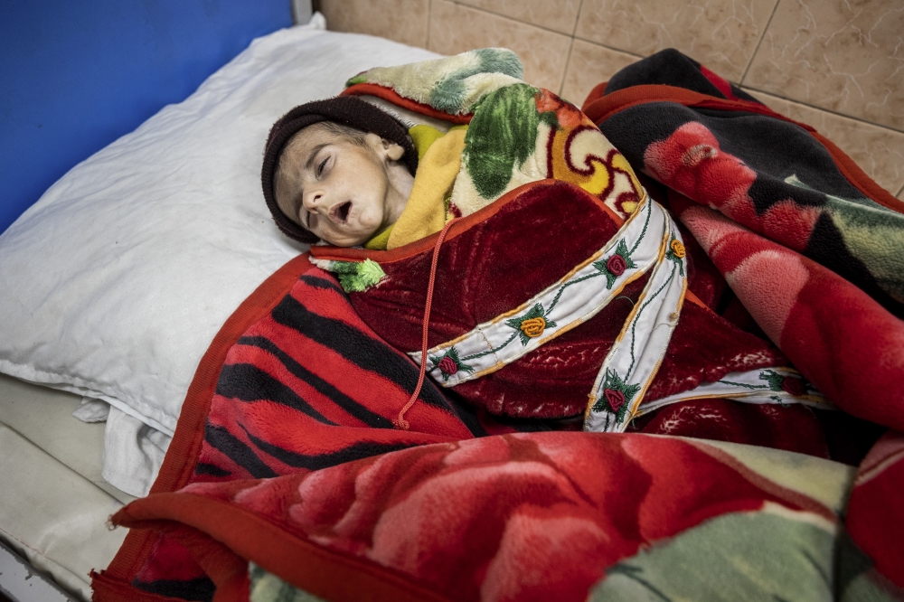 A malnourished child at the Indira Gandhi Children's Hospital in Kabul, Afghanistan, Jan. 12, 2022. (Jim Huylebroek/The New York Times)