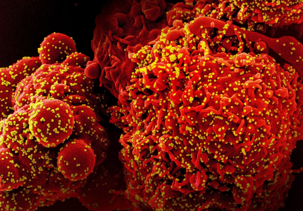 A colorized scanning electron micrograph of a cell (red) infected with Omicron virus particles, yellow.  (NIAID via The New York Times)