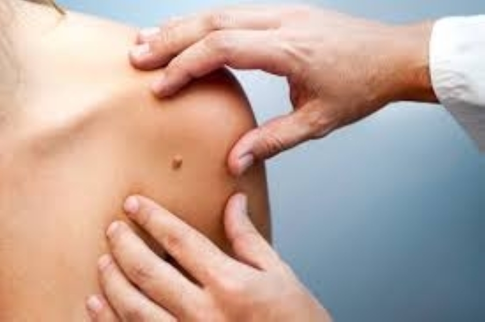 Melanoma is a cancer that typically starts in skin cells known as melanocytes that make the skin’s pigment. Compared with more common skin cancers that begin in squamous or basal cells, melanoma is more likely to spread to other parts of the body.
