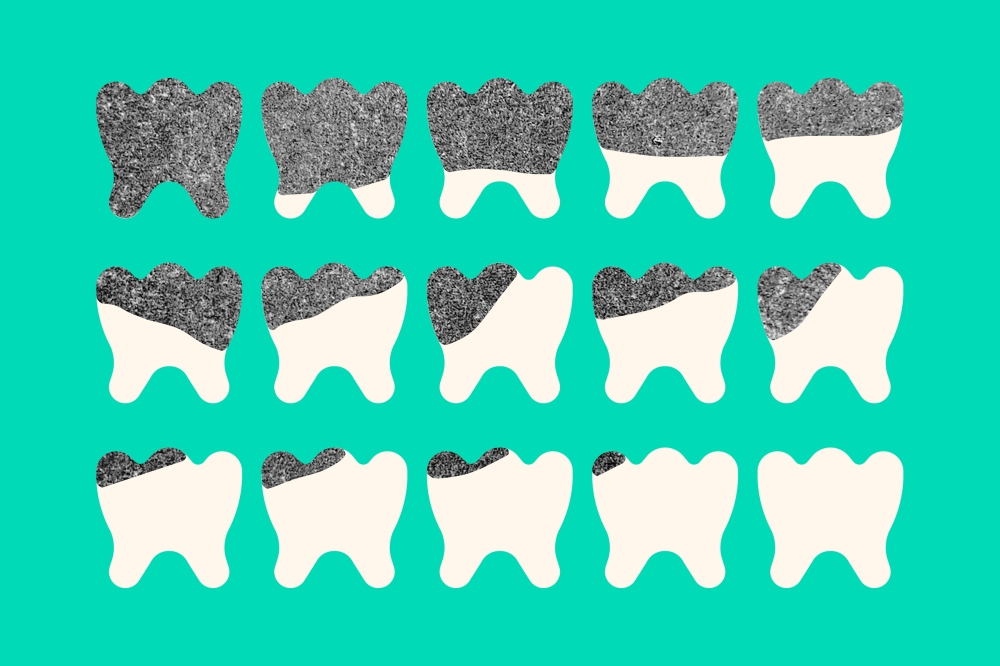 When the European Union adopted a ban on dental amalgam fillings earlier this year, its aim was to eliminate one of the last remaining intentional uses of mercury in Europe. (Giacomo Bagnara/The New York Times)