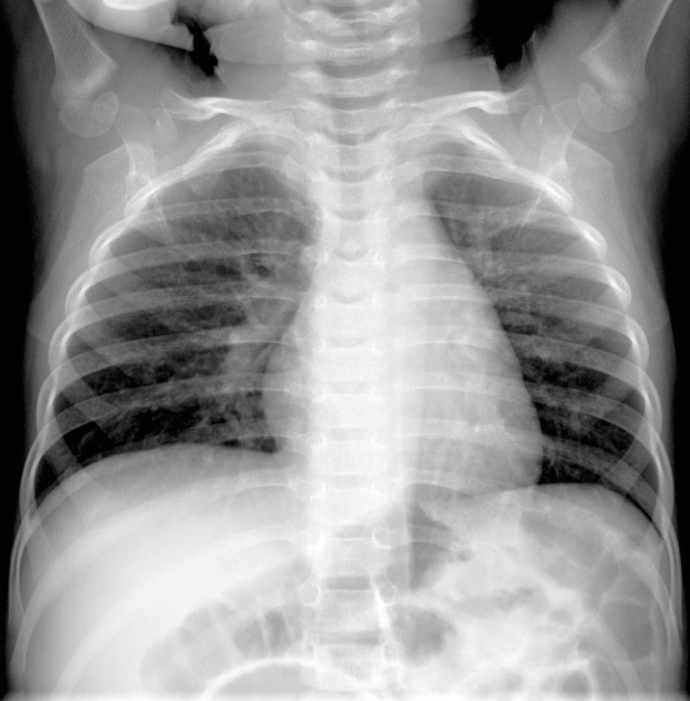 An X-ray image provided by Hilmes et al., Pediatric Radiology, 2017 shows a four-month-old boy infected with human metapneumovirus, or HMPV. 