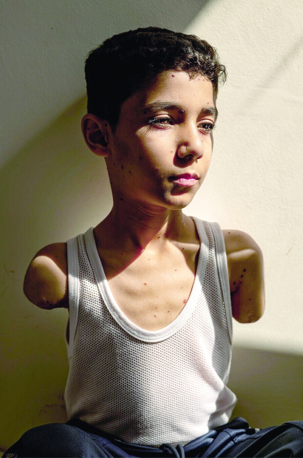 The picture depicts Mahmoud Ajjour, who lost both arms during an Israeli attack on Gaza.