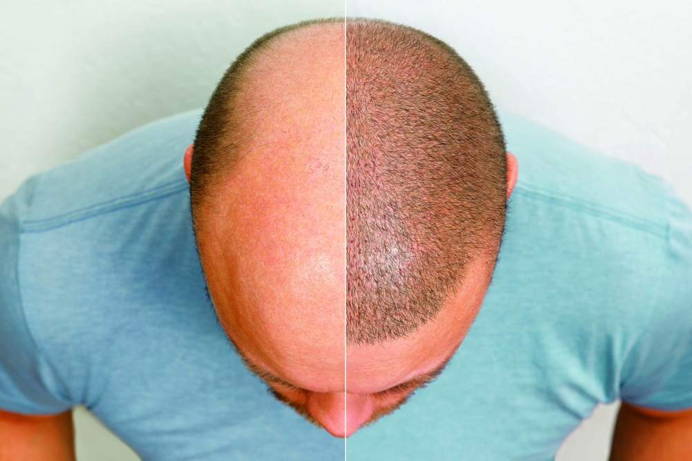 Hair transplant — The truth and the myth