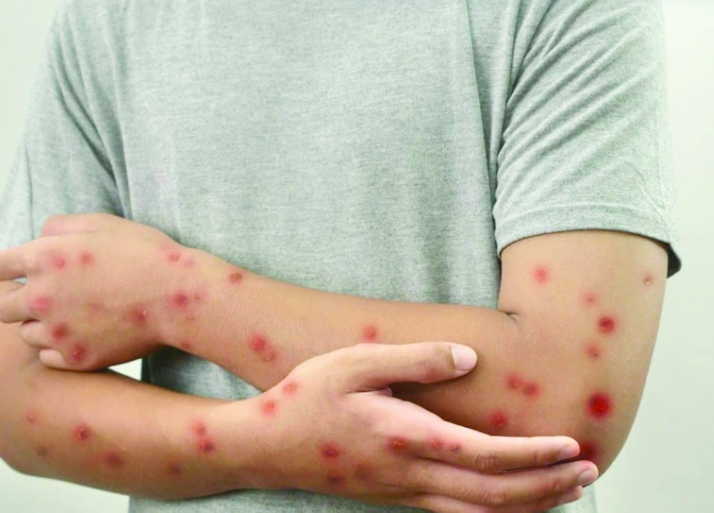 Mpox prevention guidelines issued.