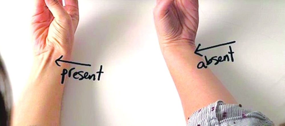Participants who lacked the muscle recorded an average grip strength of 35 kg, compared to 30 kg among those in whom the muscle was present.