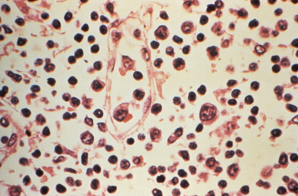 Some of the cytoarchitectural features in a lymph node specimen extracted from a patient suspected of a Hantavirus illness