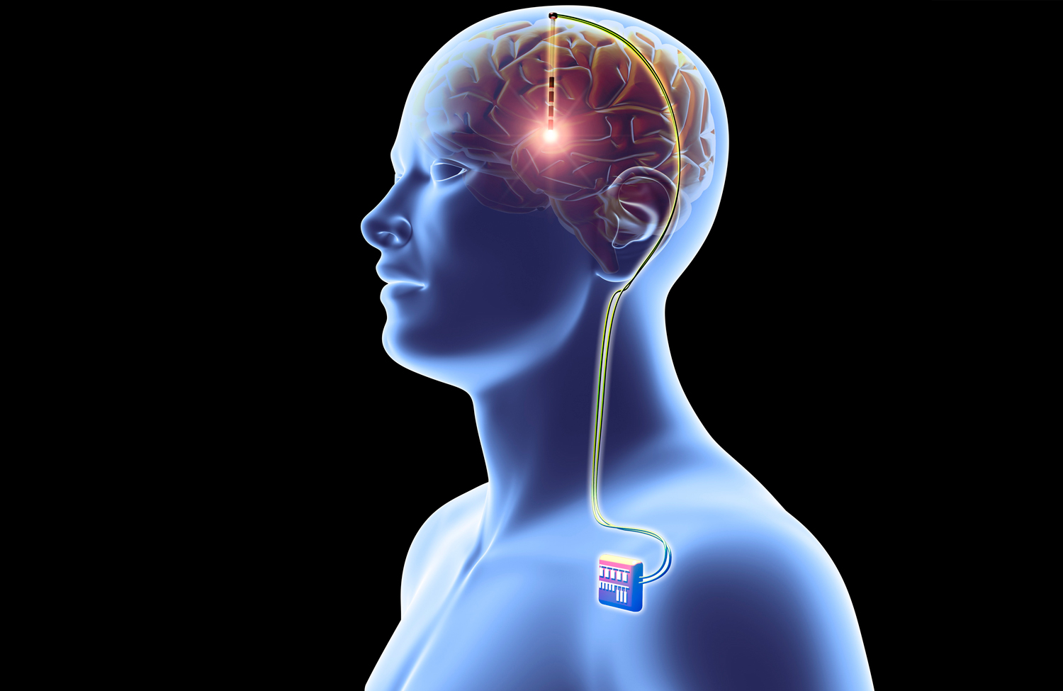 180423-brain-implant